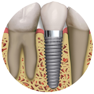 Implante:Substituição de um dente perdido por uma “raiz” artificial feita de titânio, integrada ao osso com conforto e precisão.