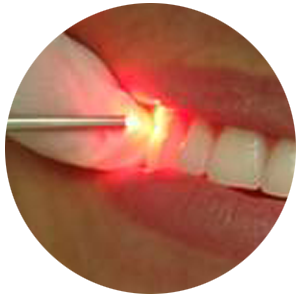 Laserterapia:Ampla aplicação na odontologia, ajuda na reparação dos tecidos, tratamento de lesões e alívio da dor.